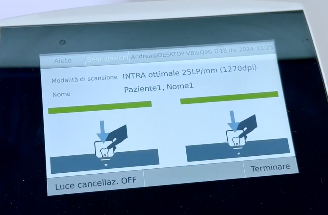 Schermata di un dispositivo odontoiatrico durante una scansione intraorale